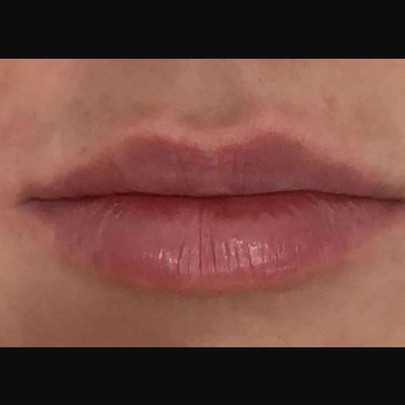 After treatment